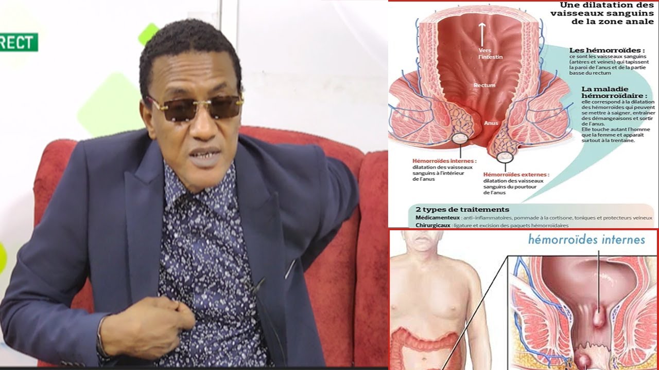 L'Hémorroïde guéri en quelques jours : Dr Abdoulaye Diallo donne la recette