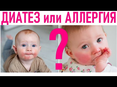 Видео: Когда у ребенка покраснели щечки?