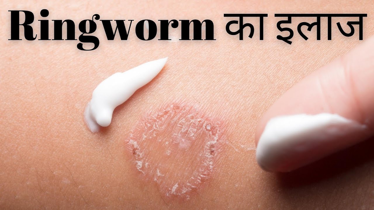 Ringworm in babies: Pictures, treatment, and natural remedies