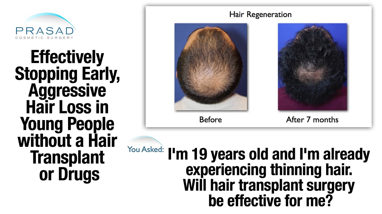 Why Hair Thinning at 19 Signals Rapid Hair Loss, and a Treatment to Stop Hair  Loss Progression - YouTube
