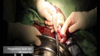 Download Lagu ProSTEM - Prosedur Pengambilan Darah Tali Pusat (Kelahiran Normal \u0026 Caesar) MP3