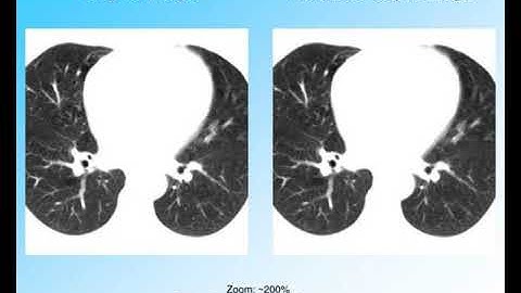 parallel beam back projection implementation