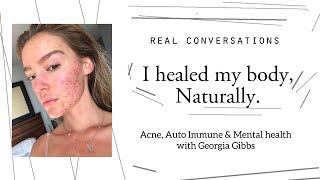 I healed Acne naturally | Real Conversations | Mental health | Georgia Gibbs