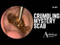 The Crumbly Plug That Just Wouldn't Come Out & A Mysterious Scab Discovery – EP1271