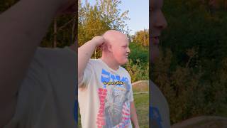 Bro Has Alopecia