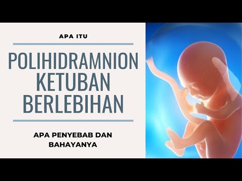 Video: Polihidramnion: Penyebab, Gejala, Pengobatan