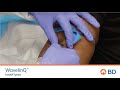 Bd wavelinq endoavf cannulation quick training with patient