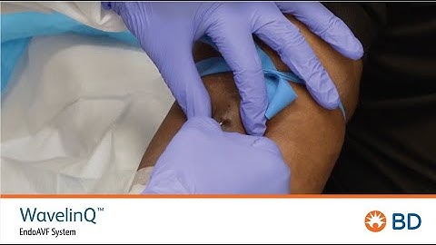 BD WavelinQ™ EndoAVF Cannulation Quick Training (with patient)