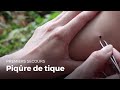 Premiers secours : Piqure de tique | Secourisme