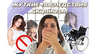 Сколиоз: СМЕЩЕНИЕ органов, КОСОГЛАЗИЕ, ИНВАЛИДНОСТЬ, НЕЛЬЗЯ рожать!