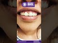 Composite fillings.#composite #dentalfilling#cosmeticfilling