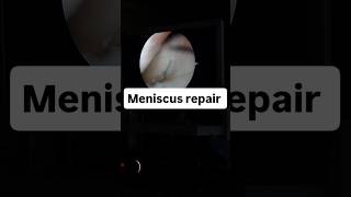 Meniscus repair in తెలుగు #shorts