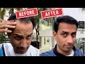 My full hair transplant journey from day 1 to  day 365  best hair transplant result in india 2023