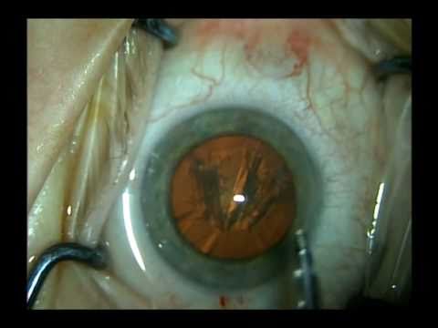 Routine cataract surgery in Real time  with narration by Shannon Wong, MD. 4-30-2011.