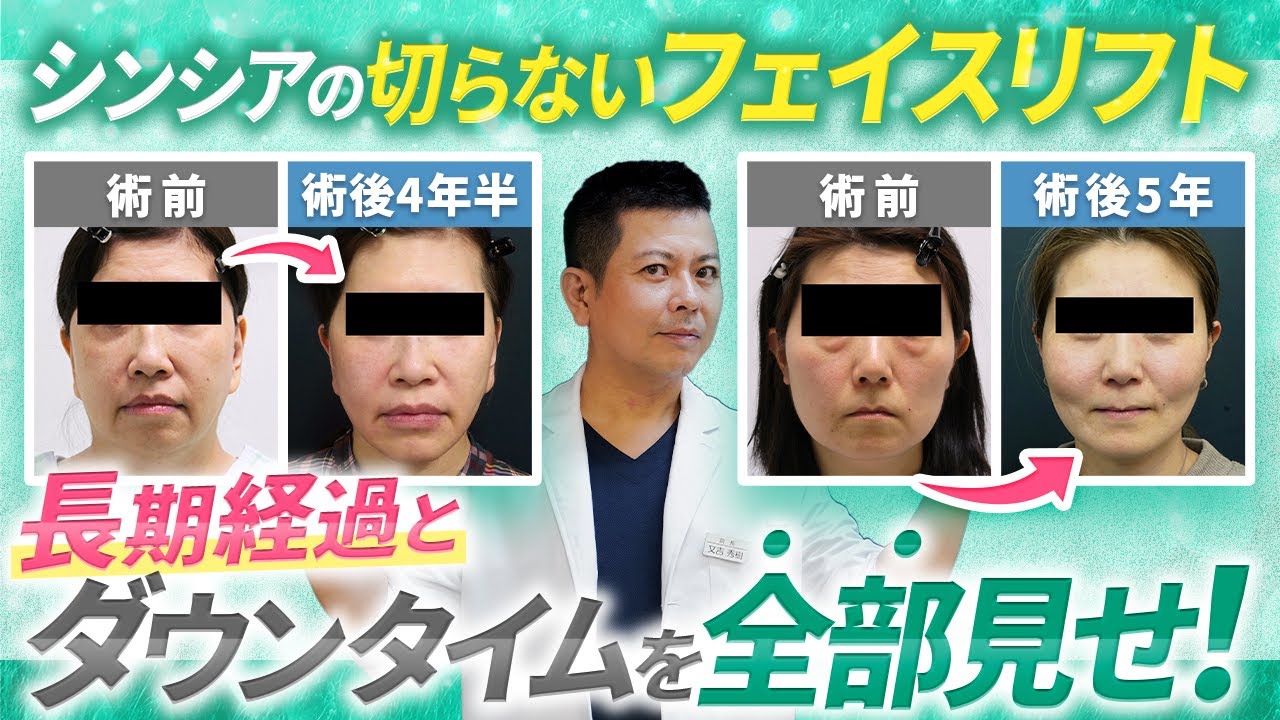【術後5年！】シンシアの切らないフェイスリフトの長期経過。ダウンタイムから効果持続の秘密まで徹底解説します！