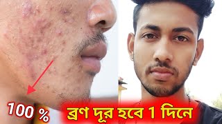 ব্রণ থেকে মুক্তি পাবেন 1 দিনে 100 % গ্যারান্টি || bron dur korar upay || How To Remove Acne Pimple screenshot 3