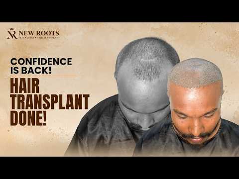 A New Hair Journey Starts Today! 🙂 | Grade 3 Baldness | Hair Transplant in Raipur | New Roots