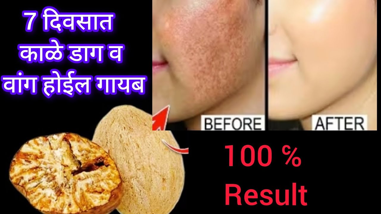 काळे डाग व वांगाची समस्या कायमची दूर करण्यासाठी घरगुती उपाय |  nutmeg face pack for pigmentation 💯