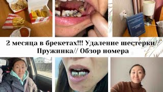 2 МЕСЯЦА В БРЕКЕТАХ🎉//ПРУЖИНКА😬//УДАЛЕНИЕ ШЕСТЕРКИ🦷⚒️//ОБЗОР БЮДЖЕТНОГО НОМЕРА В ГОСТИНИЦЕ🏨