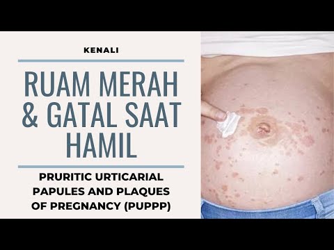 Ruam Merah & Gatal - Gatal Pada Kehamilan