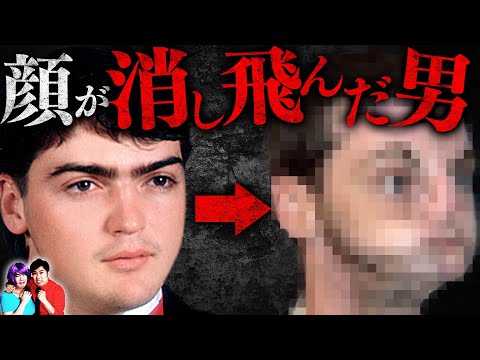 【True story】A man without half of his face. How his face transplant surgery resulted?【Scary story】