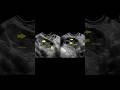 Ultrasound Battle Transvaginal vs Transabdominal