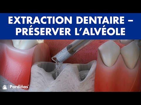 Vidéo: Extraction Dentaire: Coût, Procédure, Risques Et Récupération