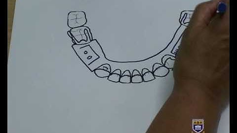 Designing a Lower Metal Partial Denture Kennedy Class III