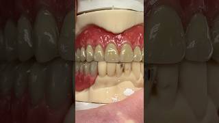 Denture and Partial Wax Try-In #dental #teeth #smile #lsk121shorts #shortvideo #shorts