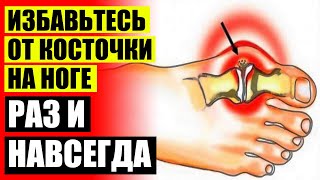 👣 Накладка на косточку большого пальца ноги отзывы 💣 Шишечки на стопе