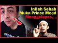 Muka Princemeed Kena Apa Sebenarnya?