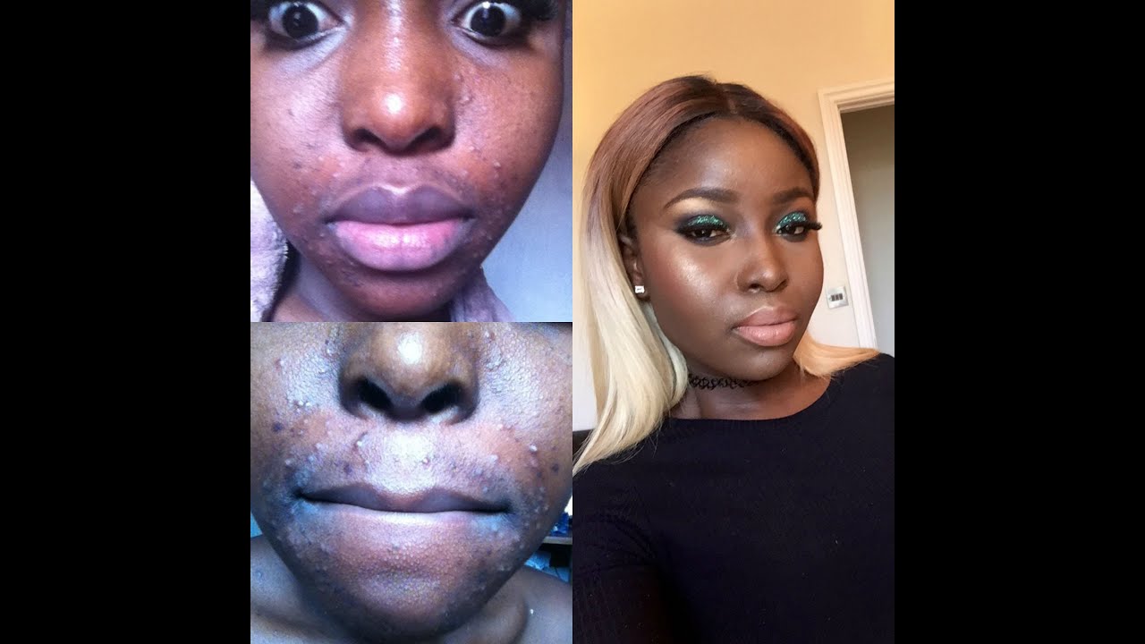 Makeup For Dark Skin With Acne Fatare Blog