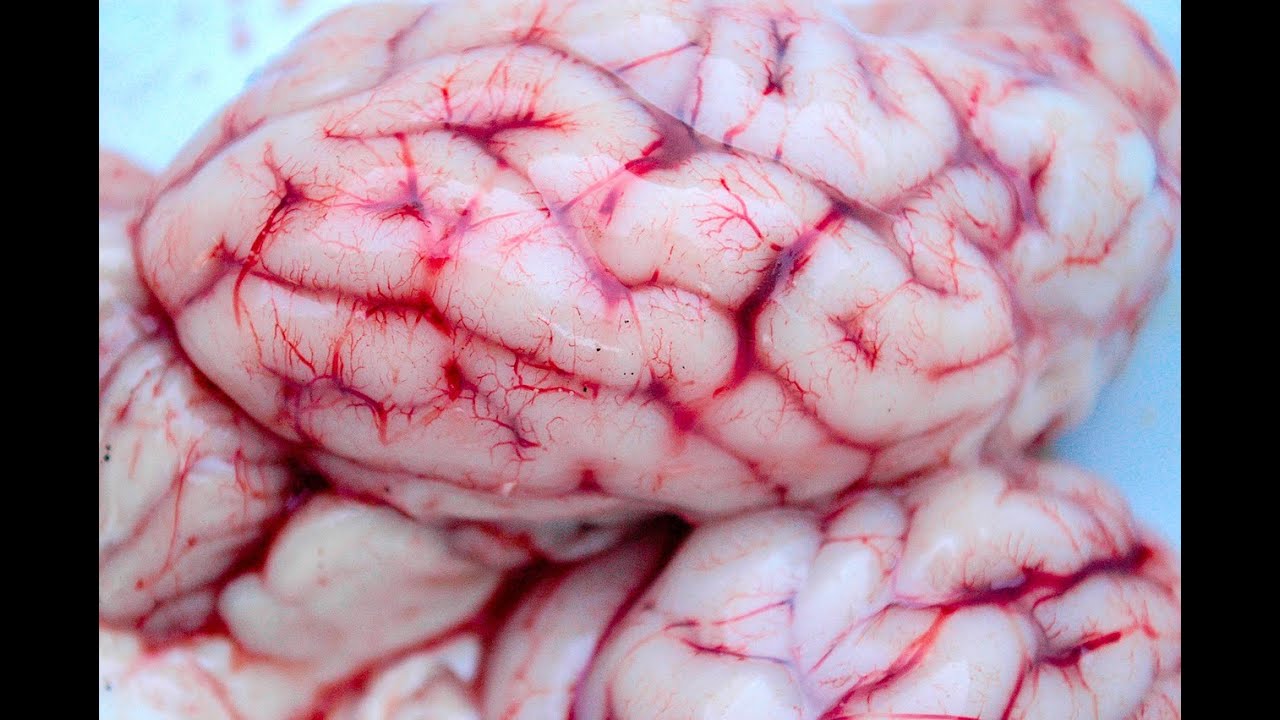 Neurologi - Skadenivå - Lokalisation - Läkare - kunskapsprov