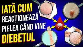 Primele Semne de Avertizare pe Piele care indică un Nivel Ridicat de ZAHĂR din Sânge