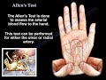 Allen's Test ,circulation of the hand  - Everything You Need To Know - Dr. Nabil Ebraheim