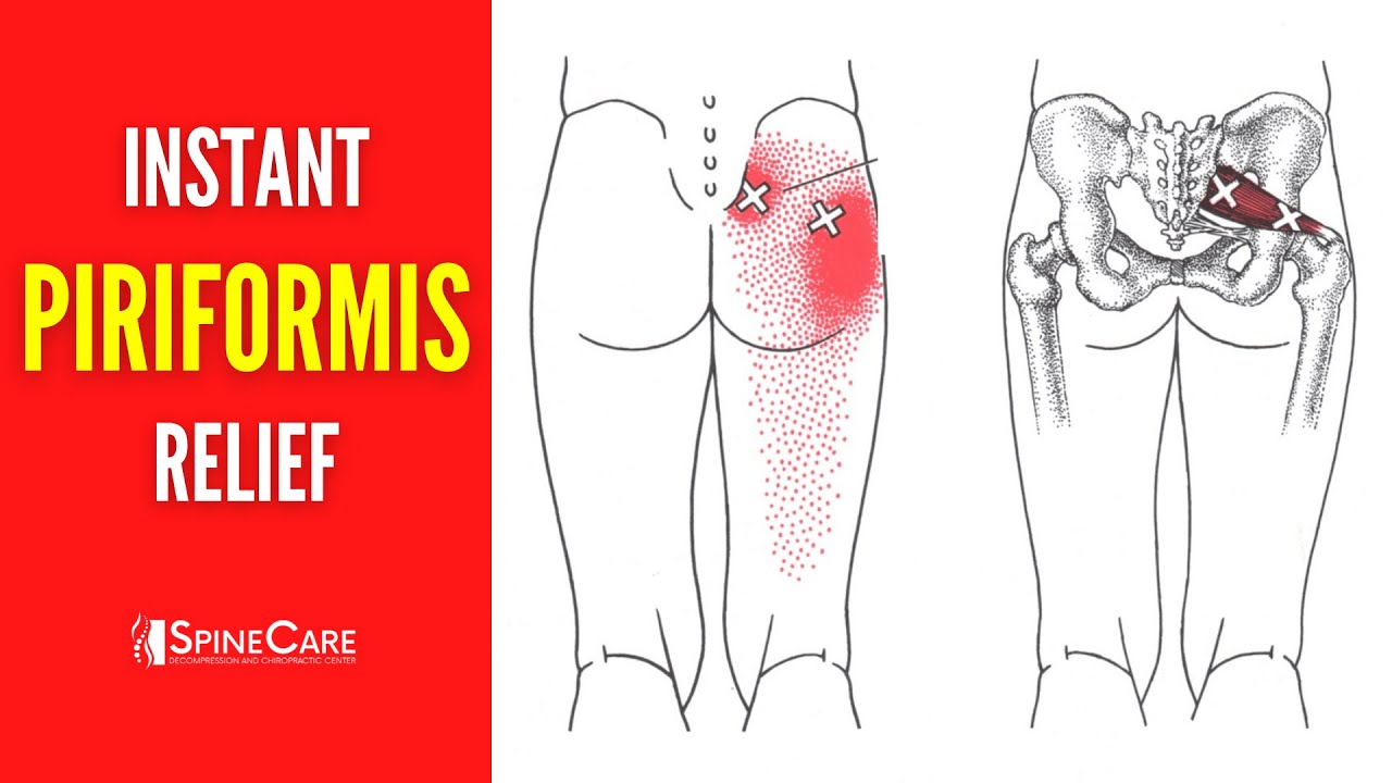 How to Get Rid of Piriformis Pain FOR GOOD 