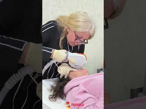 Burunətrafı damarların lazerlə müalicəsi
