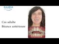 Traitement Béance ou infraclusie antérieure. Orthodontic Correction Non surgical Anterior Open Bite.