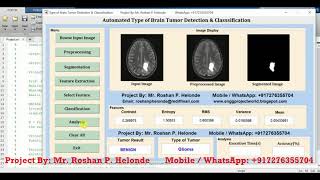 Type of Brain Tumor Detection and Classification Using Matlab Source Code
