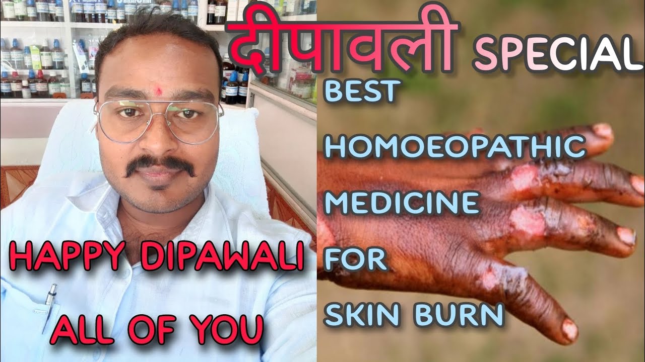 दीपावली स्पेशल जल जाने की होम्योपैथिक दवा Homoeopathic Medicine