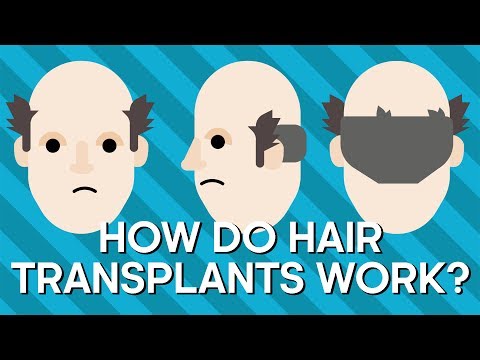 How Do Hair Transplants Work? | Earth Lab