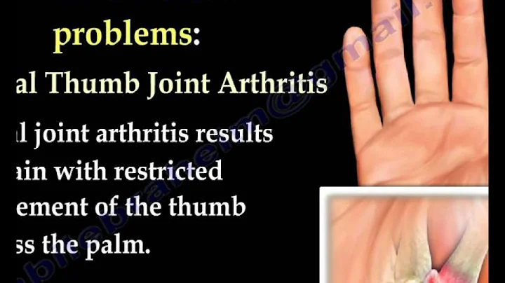 Hand Pain ,Fingers pain - Everything You Need To Know - Dr. Nabil Ebraheim