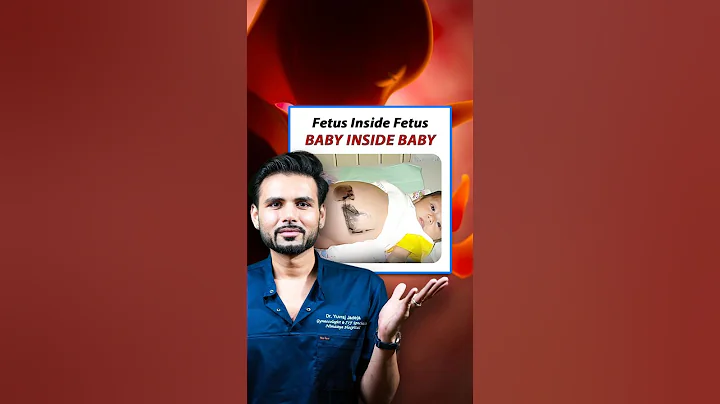 What is Fetus in fetu— the rare case of a fetus inside another Fetus! #fetus #rare