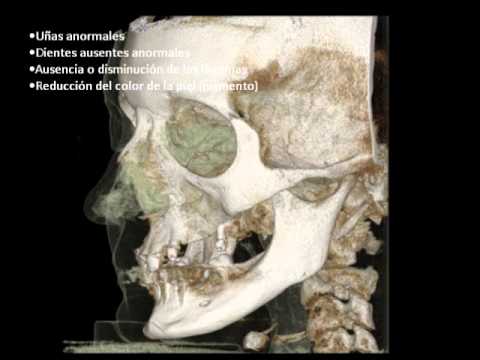 Video: Displasia Ectodermica Anidrotica: Sintomi, Trattamento, Forme, Fasi, Diagnosi