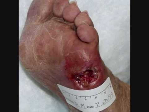 # Pictures Of Diabetic Foot Ulcers - Diabetes Care Center ...