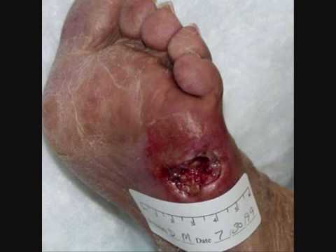 Diabetic Foot Ulcers: Pathogenesis and Management ...