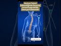 Skolyoz Tedavi Edilmediğinde Derecesi Artan Progresif bir Omurga Problemidir! #skolyoz