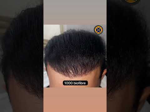 عميلنا اليوم من الامارات وقبل وبعد زراعه الف بيرفيبر Biofibre الدكتور العالمي