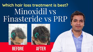 Minoxidil vs Finasteride vs PRP Therapy with Results | Which is the BEST Hair Regrowth Treatment