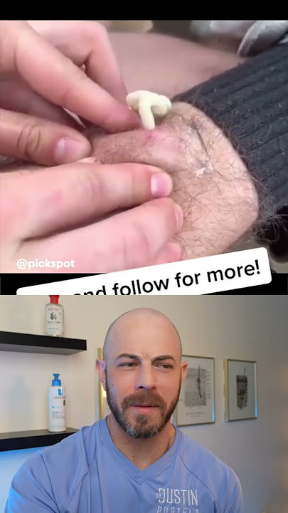 Dermatologist reacts to pus-filled cyst pop! #dermreacts #cystpopping